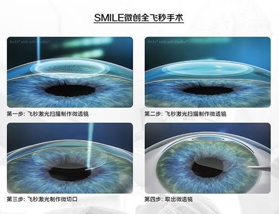 蔡司全飛秒、蔡司半飛秒近視手術(shù)與宇航飛秒的區(qū)別
