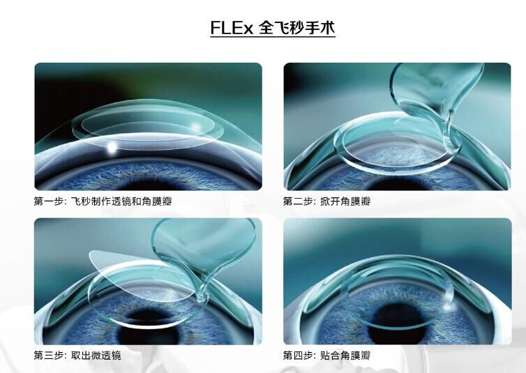 蔡司全飛秒、蔡司半飛秒近視手術(shù)與宇航飛秒的區(qū)別
