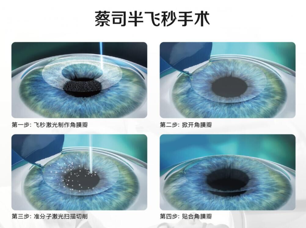 蔡司全飛秒、蔡司半飛秒近視手術(shù)與宇航飛秒的區(qū)別