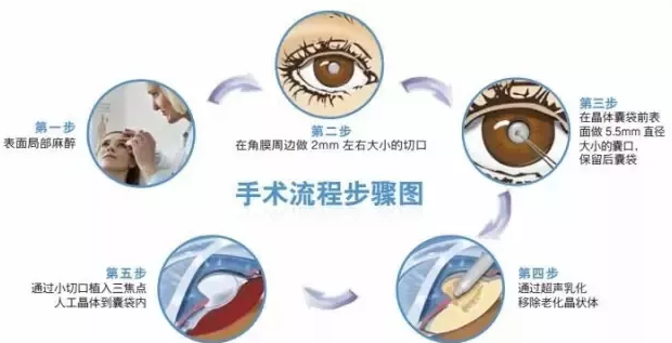 12月23日，普瑞眼科白內(nèi)障患者答謝會邀您參加!